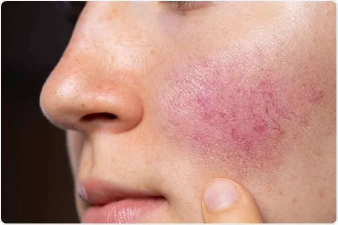 Flushing and Redness: The First Signs of Rosacea